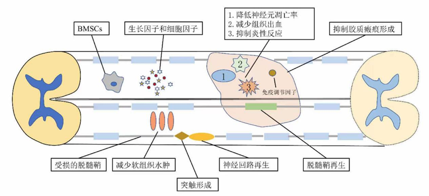 盘点近2年干细胞治疗脊髓损伤临床进展：我国启动临床招募，多名患者得到改善(图9)
