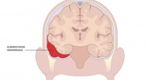 脂肪来源干细胞外泌体通过AMPK/mTOR介导的TFEB激活促进蛛网膜下腔出血后的神经功能恢复